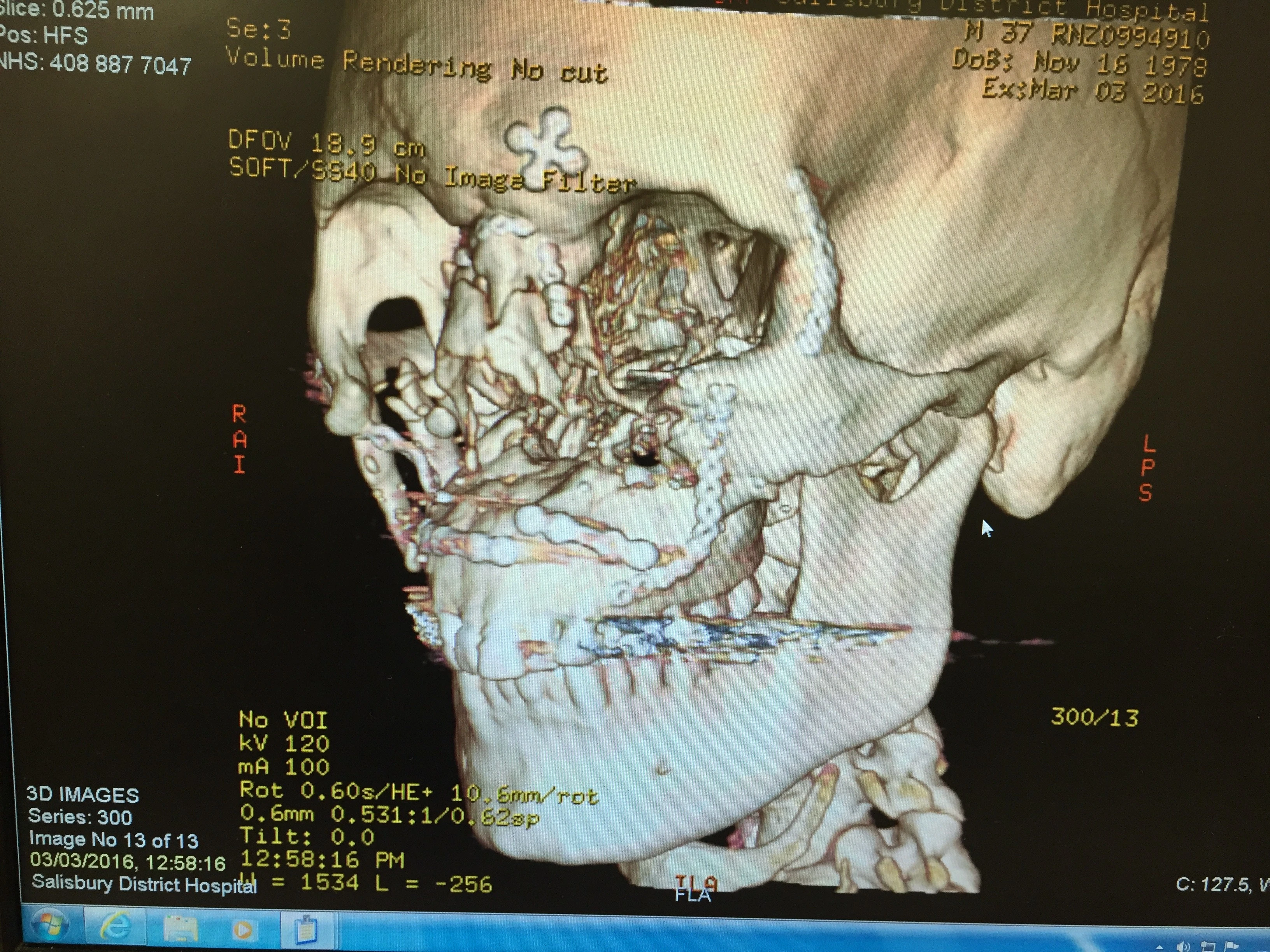 Simon Brown X-ray